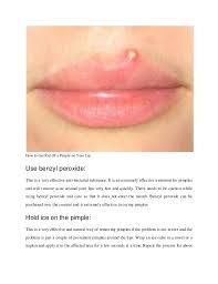 One of them is pimple on lip, it can be even worse. How To Get Rid Of A Pimple On Your Lip