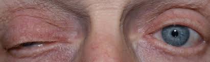 Image result for Pupillary Paralysis