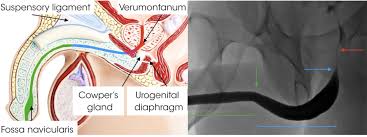 Image result for Retrograde Urethrogram