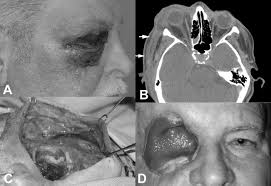 Program within @mayoclinicgradschool is currently accepting applications! Periocular Necrotizing Fasciitis With Visual Loss Ophthalmology