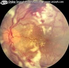Узелковый полиартериит у детей начинается остро: Atlas Of Ophthalmology