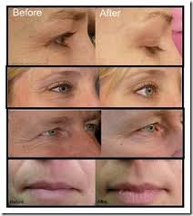 Red Light Therapy Dpl Therapy System Red Light Therapy Red Light Therapy Results Red Light Therapy Benefits