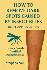 Image result for mosquito bite