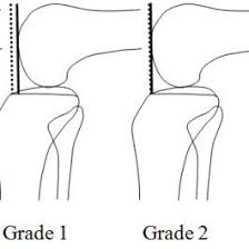 Using ultrasound imaging during performance of the the anterior drawer test the talofibular interval was measured digitally. Posterior Drawer Test This Is Done By Determining The Distance Of The Download Scientific Diagram