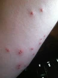 Image result for ant bite