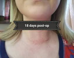 Life After Thyroidectomy Parathyroidectomy Photos Thyroidectomy Thyroid Surgery Levothyroxine