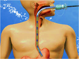 Image result for Wireless Capsule Endoscopy