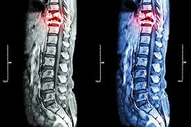 Sometimes breast cancer spreads to other parts of the body, like the bones<, the liver, or elsewhere. Bisphosphonates Vs Denosumab Preventing Sres In Breast Cancer With Bone Metastasis Oncology Nurse Advisor