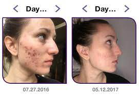 Only slight spotting here and there. B A Cystic Acne Gone After Iud Mirena Removal Skincareaddiction