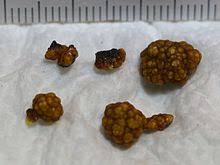The term cholelithiasis may refer to the presence of gallstones or to any disease caused by gallstones, and choledocholithiasis refers to presence of migrated gallstones within bile ducts. Gallenstein Wikipedia