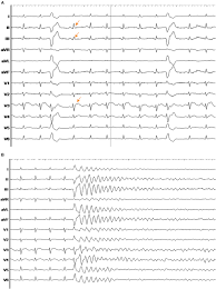 Image result for Early Repolarization