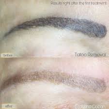 The contour of the tattoo, you can pull out the hairs on their own, without fear of spoil created in the how to choose the form and color of eyebrows. Microblading Removal When And How To Do It Pmuhub