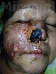 La mucormicosis cutánea se clasifica en dos formas: Caso Clinico NÂº 63 Piel L Latinoamericana