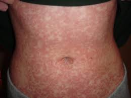 Most people are infected by the virus as children, when the disease produces few or no symptoms. Body Rash Mdedge Family Medicine