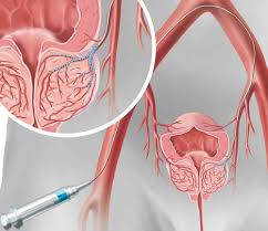 Minimalinvasiver Gefassverschluss Lasst Vergrosserte Prostata Schrumpfen Hirslanden
