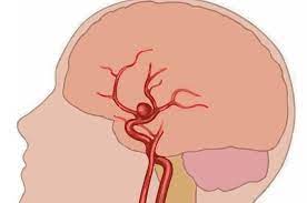 Approfondiamo le caratteristiche e le tipologie dell'aneurisma. Aneurisma Dapat Sebabkan Serangan Jantung Ini Alasannya