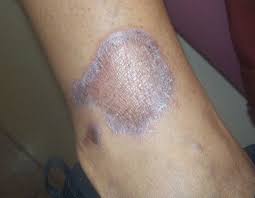 The lesions are arranged in a circular fashion, or they become so by peripheral extension with central clearing. Clinical Challenge Hyperpigmented Lesions With Raised Borders