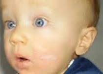 智力迟钝相关资讯-临床研究进展，文献-MedSci.cn