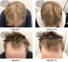 Women typically retain the hairline on the forehead but have a broadening of the part in. Hair Growth Success Found Staff Very Pleasant And Helpful