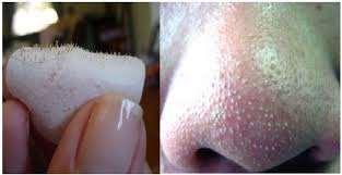 Gunakan skincare yang dapat selesaikan masalah bintik hitam ini pilih yang terbukti berkesan dan. Petua Hilangkan Bintik Hitam Di Hidung 8 Petua
