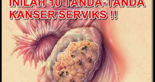 10 Tanda Awal Anda Kena Kanser Serviks 2 Minit Baca Post Ini Boleh Selamatkan Nyawa Anda Kanser Pangkal Rahim Atau Serviks Adalah Sejenis 10 Things World