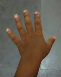 Check spelling or type a new query. Short And Stubby Fingers Rough Skin Open I