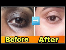 Keep your lips always moisturized. How To Remove Dark Circles Permanently Remove Dark Circles Under Eyes Naturally In One Week Youtube