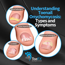 Image result for onychomycosis