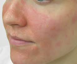 You should figure out which vitamins and minerals you two of the vitamins that help with healthy skin and getting rid of eczema include vitamin b12 and vitamin e. Facial Eczema Treatment Causes Symptoms Dermatitis Types Cream Relief