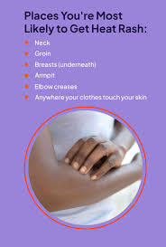 Image result for heat rash under breasts