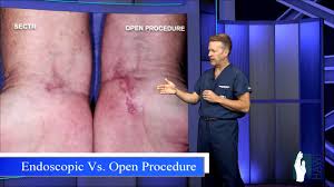 What is the recovery time for carpal tunnel surgery. Carpal Tunnel Release Open Procedure Vs Endoscopic Youtube