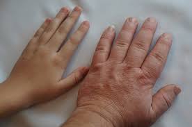 Diabetes insipidus adalah hasil dari kekurangan hormon antidiuretik pada kista sumbing rathke, kantong rathke akhirnya membentuk kelenjar pituitari dan biasanya. Awas Inilah Penyebab Akromegali Yang Perlu Diketahui