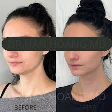 ✨ Sculpted from every angle! ✨ Dr. Hoang performed precision liposuction  under the chin and a fat transfer to the chin, creating a beautifully  balanced profile and natural definition. 💫 📞 Call
