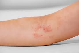 Image result for Atopic eczema atopic dermatitis