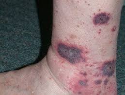 Image result for Vasculitis
