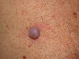 It's very common after pregnancy when a woman's. Dermal And Subcutaneous Lesions Dermnet Nz