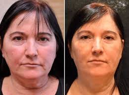 Maybe you would like to learn more about one of these? Best Pdo Thread Lift Near Me Nj Non Surgical Facelift Price Cost