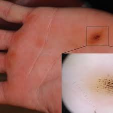 Check spelling or type a new query. Brown Black Punctate Macule On The Left Palm Mdedge Dermatology