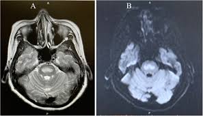 Broad exact {{getslidervalue(config)}} year range: A Case Of Osmotic Demyelination Syndrome Detected After Cesarean Delivery With The Administration Of Magnesium Sulfate For Threatened Preterm Labor Ja Clinical Reports X Mol