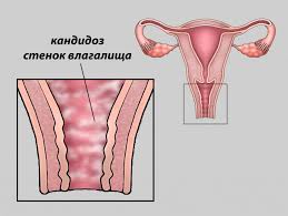 — щеки горят — к слезам; Zud I Zhzhenie Vo Vlagalishe Prichiny Simptomy Lechenie