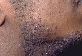 The legendary larry the barber man also puts an emphasis on how important shaving direction is as a treatment for razor bump prevention for black males. Picture Of Razor Bumps