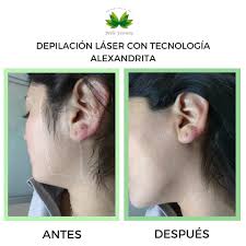 Depilacion Laser De Patillas Online Deals Up To 70 Off Www Pcyredes Com