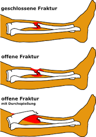 Sanitatsausbildung Verletzungen Wunden Verbrennung Frakturen Merkmale Und Gefahren Von Frakturen Virtuelle San Arena Erlangen