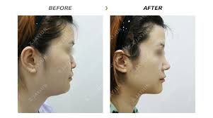 Korean Plastic Surgery Korea Cosmetic Surgery Korean Plastic Surgery Before And After Cosmetic Su Plastic Surgery Korea Korean Plastic Surgery Cosmetic Surgery