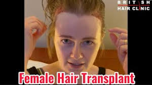'Female Hair Transplant'