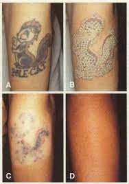 In the course of our lives, we always do something that we regret and we wished we could undo, like a bad hair dye, a bad haircut. Tattoo Removal Washington Institute