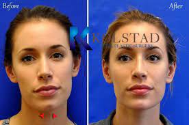 How long do cheek fillers last? Chin Jawline Filler Results Dr Kolstad San Diego Facial Plastic Surgeon