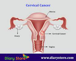 Nearly all cases of cervical cancer are caused by hpv, a sexually transmitted disease. Cervical Cancer Cervical Cancer Symptoms Causes Treatment