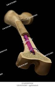 □ compact tissue, it is dense in texture and it is always the osteoblasts form a collar of compact bone around the diaphysis. Cross Section Of A Femur Bone Showing The Anatomical Structure Including Cancellous Bone And Marrow Stock Photo Picture And Rights Managed Image Pic Sjb 4378 2851 Agefotostock