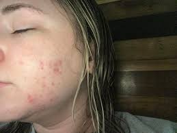 Side effects of the non hormonal iud planning